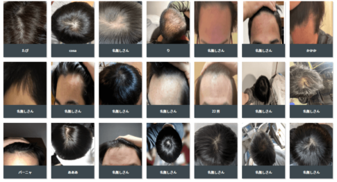 つむじはげおでこはげはどこから？禿げてるかどうか写真(画像)を投稿する投票サイトを紹介！ - 彩blog
